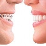 Dentist Alcala Henares 1 Dental Clinic Orthodontists Invisibles Brackets