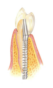 Dentista Alcala Henares | Clinica Dental Implantes Dientes Muelas